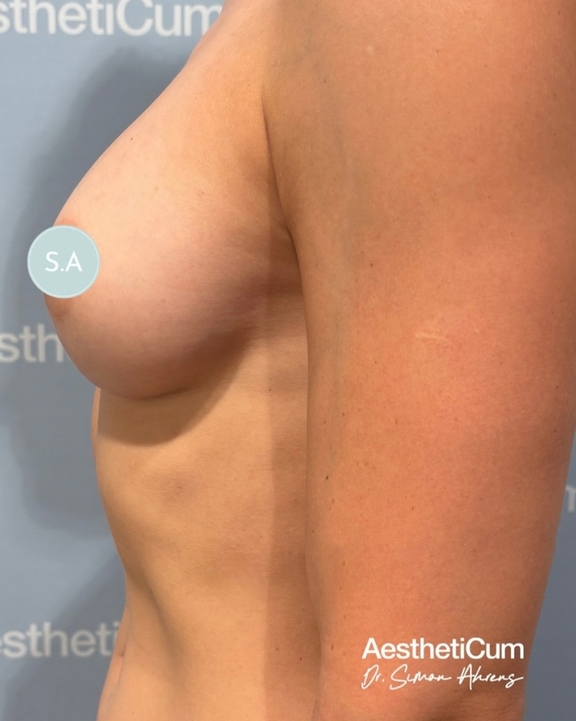 aestheticum-berlin-brustvergroesserung-ergebnis16.jpg