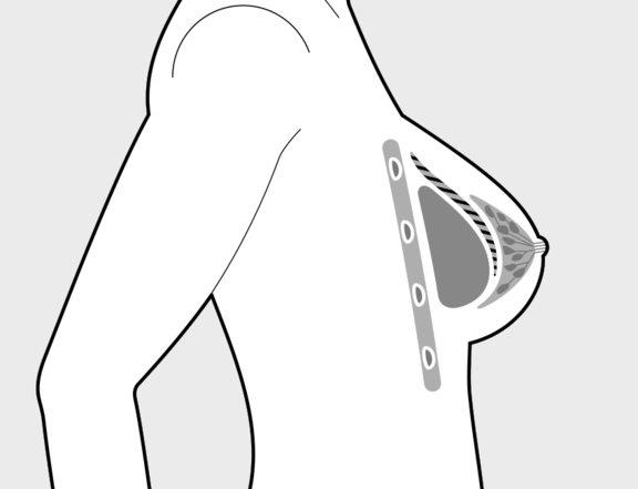 Brustvergrößerung mit Implantat, Plastische Chirurgie Berlin, AesthetiCum, Dr. Ahrens, Dr. Fritzsch
