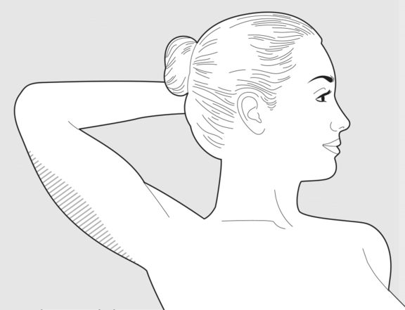Fettabsaugung Oberarm, Plastische Chirurgie Berlin, AesthetiCum, Dr. Ahrens, Dr. Fritzsch
