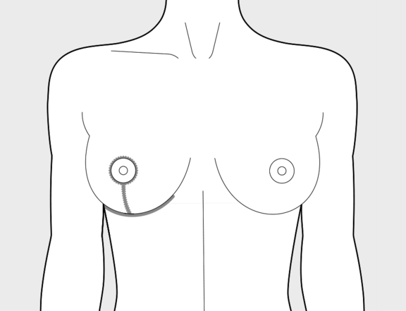 Bruststraffung, nachher, Plastische Chirurgie Berlin, AesthetiCum, Dr. Ahrens, Dr. Fritzsch