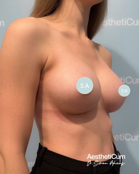 aestheticum-berlin-brustvergroesserung-ergebnis10.jpg
