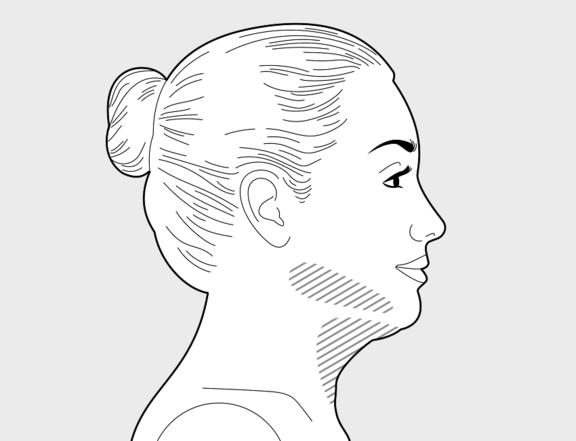 Fettabsaugung Kinn und Hals, Plastische Chirurgie Berlin, AesthetiCum, Dr. Ahrens, Dr. Fritzsch