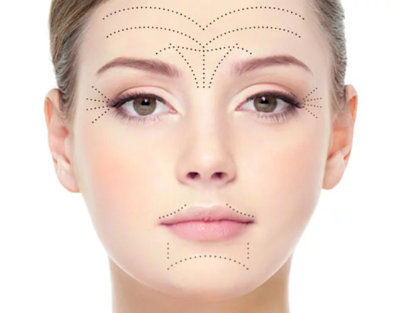 Einzeichnung Botox, Plastische Chirurgie Berlin, AesthetiCum, Dr. Ahrens, Dr. Fritzsch